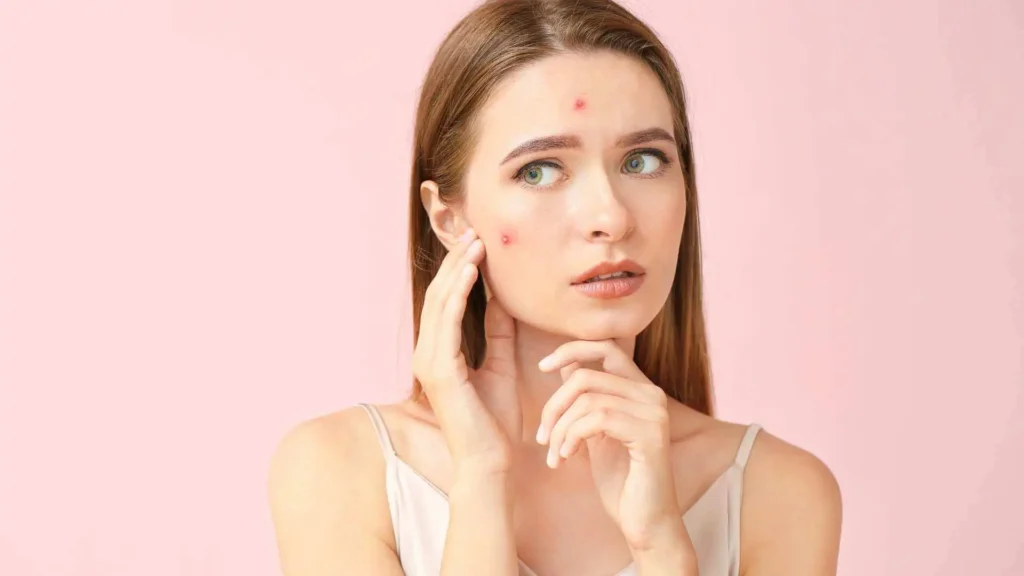 Rosto de mulher com acne e imperfeições na pele, indicando inflamação na pele
